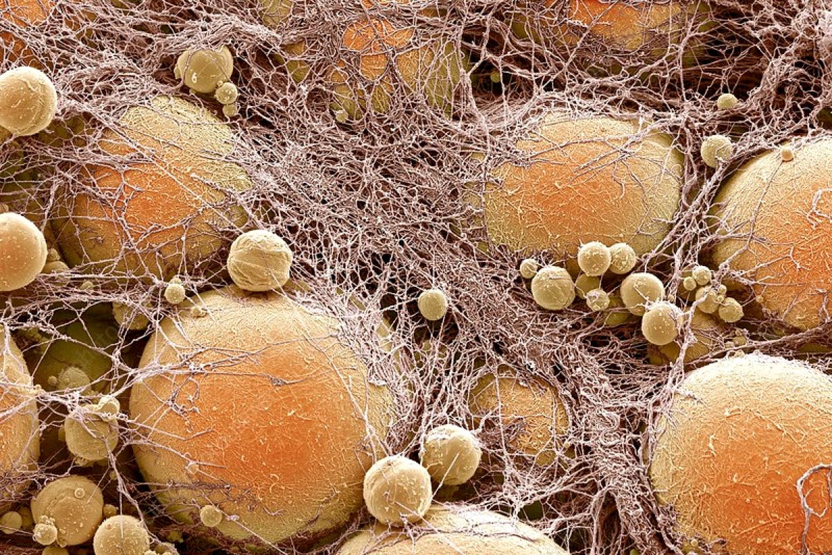 Scientists use engineered fat cells to starve tumors, halting cancer growth across multiple types in lab studies.